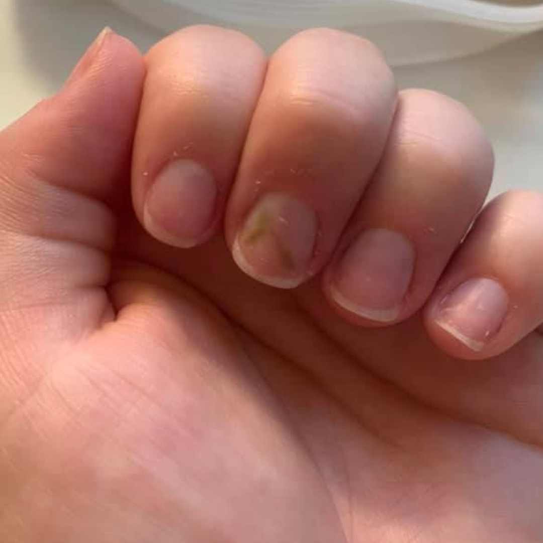 Discolored nails can be a sign of these hidden health issues